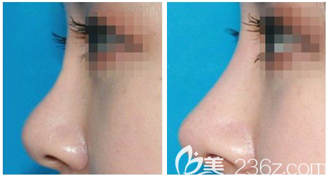 惠州伊麗莎白金鴻院長(zhǎng)隆鼻案例對(duì)比圖