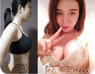 惠州伊麗莎白金鴻院長(zhǎng)做的隆胸案例