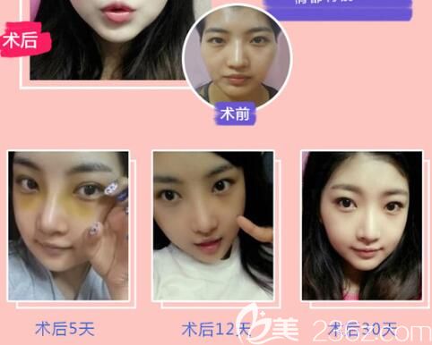 遵義利美康自體脂肪全臉填充