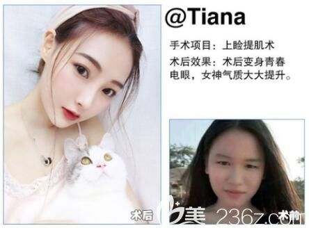 利美康上瞼提肌矯正