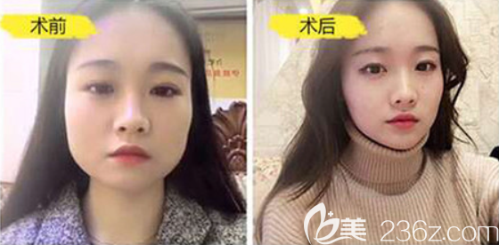 遵義利美康黃磊兵瘦臉案例