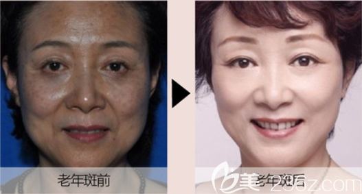 遵義利美康祛斑怎么樣