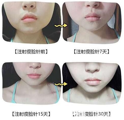 遵義利美康龍文萍瘦臉案例