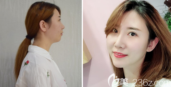 東莞韓美王仁斌醫(yī)生做的隆鼻和豐下巴手術(shù)案例