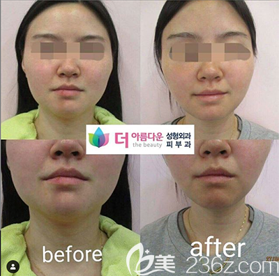 韓國thebuty整形外科真申稼面部吸脂案例 韓國thebuty整形外科真申稼面部吸脂案例