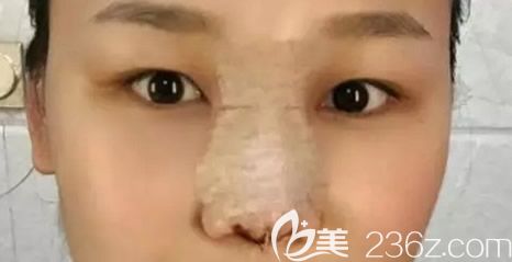 自體軟骨綜合隆鼻第二天效果 自體軟骨綜合隆鼻第二天效果