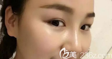 呼市華美鼻部綜合手術(shù)第七天拆線后圖片 呼市華美鼻部綜合手術(shù)第七天拆線后圖片