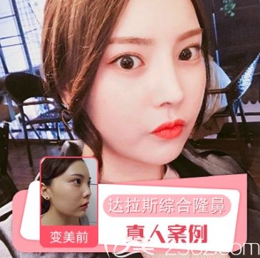 張凱鼻綜合案例