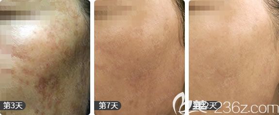 杭州薇琳陳丹激光祛黃褐斑<span style= 杭州薇琳陳丹激光祛黃褐斑<span style=