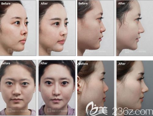 崔寓植院長隆鼻手術(shù)案例