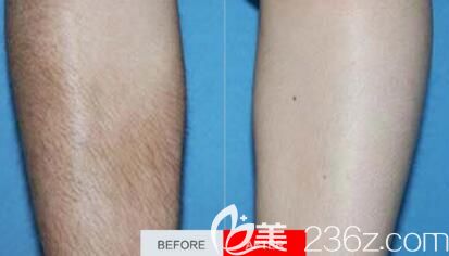 沈陽元辰醫(yī)美冰點脫腿毛前后效果對比圖