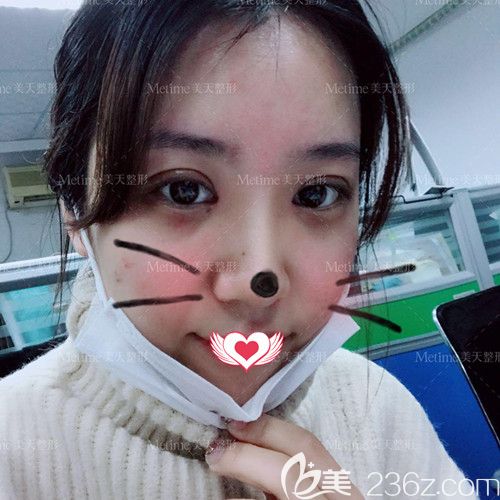 郭東超為我做眼綜合術(shù)后3天雙眼皮腫脹 郭東超為我做眼綜合術(shù)后3天雙眼皮腫脹