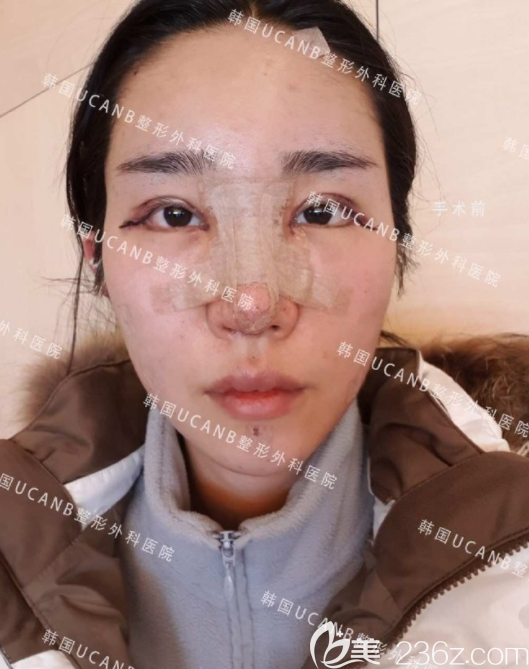 在韓國(guó)UcanB整形外科李芳碩做了雙眼皮、鼻子、脂肪填充，呆傻笨得我也軟萌起來(lái)