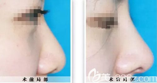 整形醫(yī)院做假體隆鼻案例 整形醫(yī)院做假體隆鼻案例
