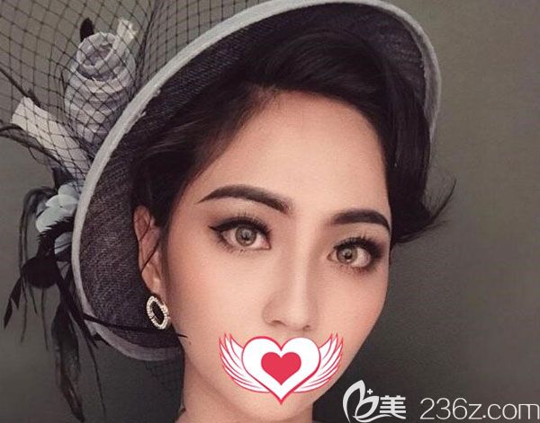 肋軟骨隆鼻兩個月沒有出現(xiàn)什么異物感