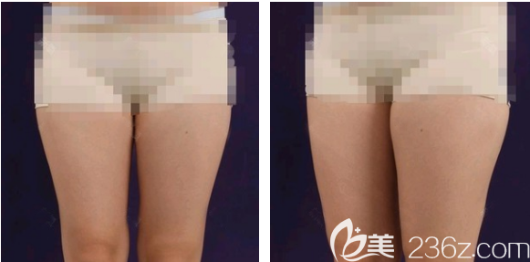 在東莞美立方做大腿吸脂手術(shù)前 在東莞美立方做大腿吸脂手術(shù)前