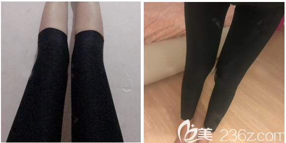 大腿吸脂減肥術(shù)后11天效果 大腿吸脂減肥術(shù)后11天效果