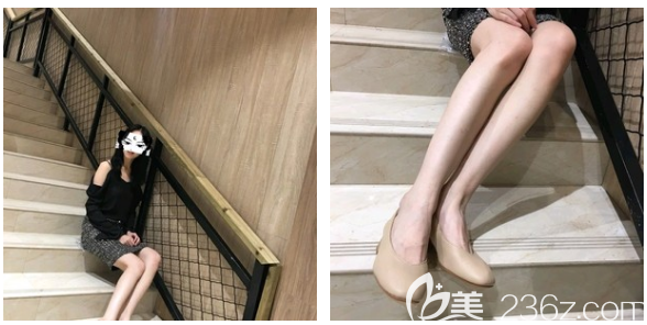 東莞抽脂哪家好？看我花一萬多元找東莞美立方李志剛做的大腿吸脂效果