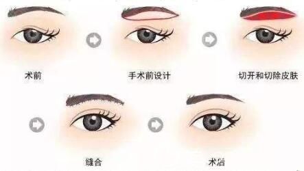 切眉術的手術過程