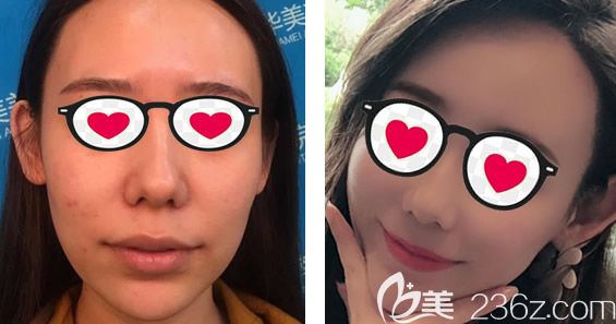 呼和浩特華美<!--<i data=20240703-sp></i>-->做全臉脂肪填充的效果怎么樣