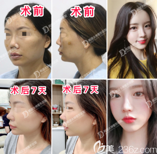 鼻子修復韓國女神