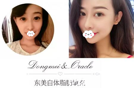 綿陽東美奧克拉盧元剛自體脂肪面部填充效果