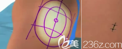 水動力吸脂切口