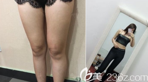 水動力吸脂大腿案例
