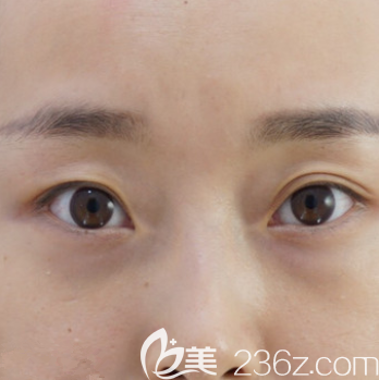 在北京藝美做埋線雙眼皮前樣子 在北京藝美做埋線雙眼皮前樣子