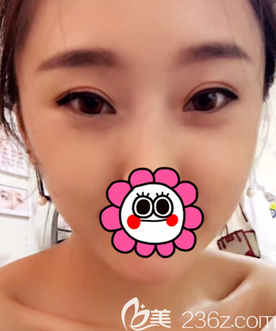 在北京藝美做埋線雙眼皮第28天效果 在北京藝美做埋線雙眼皮第28天效果