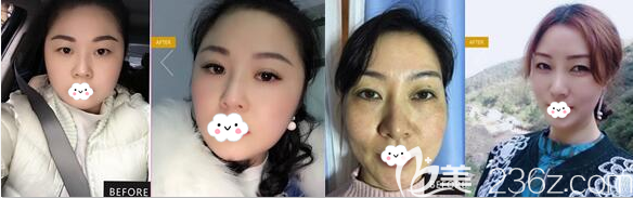 綿陽妙典雙眼皮+脂肪填充面部案例