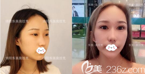 綿陽東美奧克拉整形周雪雙眼皮術后對比照