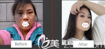 綿陽朗睿王步禮祛太田痣真實案例