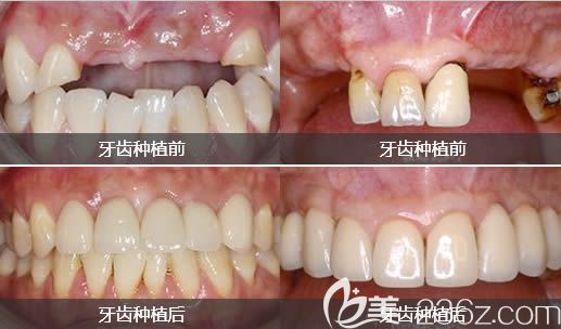 <!--<i data=20240703-sp></i>-->口腔牙齒種植前后對比圖 <!--<i data=20240703-sp></i>-->口腔牙齒種植前后對比圖