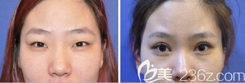 江油白天鵝整形美容醫(yī)院余強雙眼皮術前術后對比圖