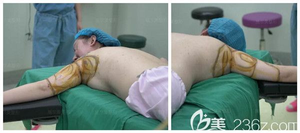 上臂環(huán)吸術(shù)前的劃線設(shè)計(jì)