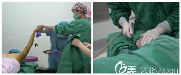 李彤彤醫(yī)生消毒后做吸脂手術(shù)中