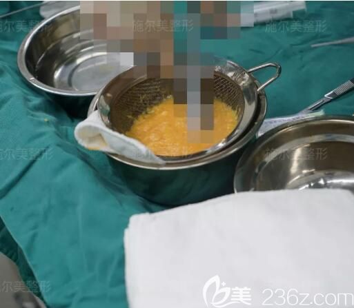 上臂環(huán)吸抽取出來的脂肪細(xì)胞