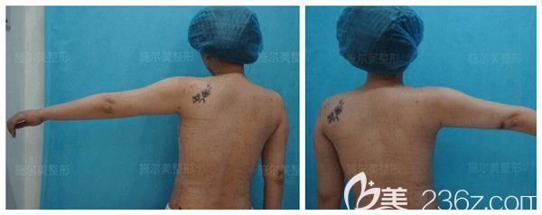 剛做完術(shù)后即刻上臂環(huán)吸效果展示