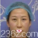 在天宏整形醫(yī)院做完自體脂肪填充前面部凹陷顯老 在天宏整形醫(yī)院做完自體脂肪填充前面部凹陷顯老