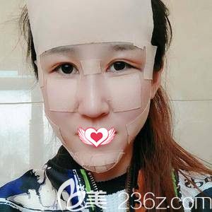 孫蘇寧醫(yī)生為我做完全面部填充脂肪術(shù)后3天慢慢消腫 孫蘇寧醫(yī)生為我做完全面部填充脂肪術(shù)后3天慢慢消腫