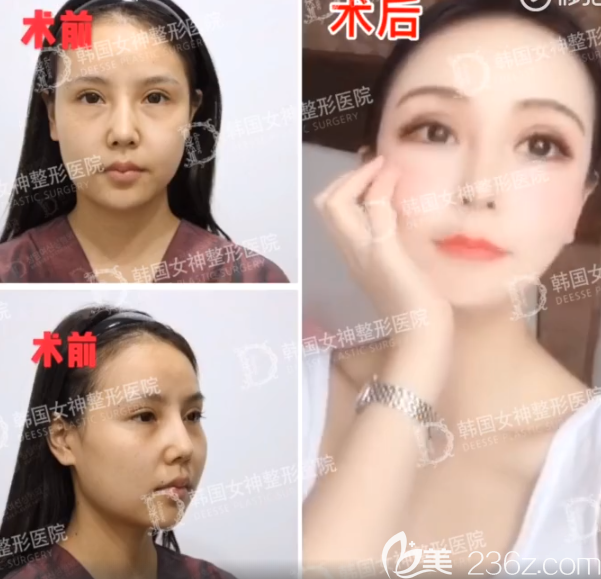 女神醫(yī)院輪廓3件套 術前+術后6個月 女神醫(yī)院輪廓3件套 術前+術后6個月