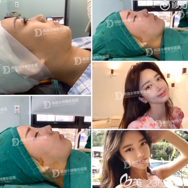 韓國女神隆鼻真人案例 韓國女神隆鼻真人案例