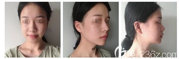 面診南通儷人連天美術前面部松弛下垂明顯 面診南通儷人連天美術前面部松弛下垂明顯