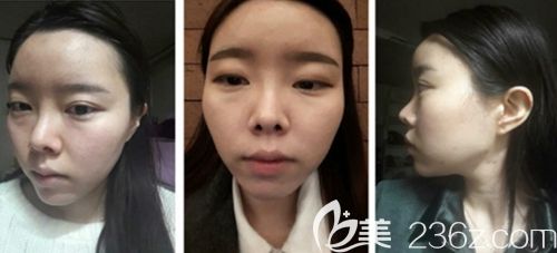 在韓國新帝瑞娜做眼鼻整形+面部輪廓手術(shù)前 在韓國新帝瑞娜做眼鼻整形+面部輪廓手術(shù)前