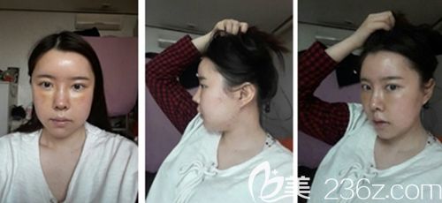 在韓國新帝瑞娜做眼鼻整形+面部輪廓手術(shù)后1周 在韓國新帝瑞娜做眼鼻整形+面部輪廓手術(shù)后1周