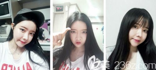 在韓國新帝瑞娜做眼鼻整形+面部輪廓手術(shù)后3個(gè)月 在韓國新帝瑞娜做眼鼻整形+面部輪廓手術(shù)后3個(gè)月