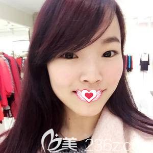 在石家莊天宏做雙眼皮術(shù)前是無神單眼皮 在石家莊天宏做雙眼皮術(shù)前是無神單眼皮