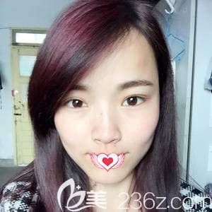 天宏整形醫(yī)生孫蘇寧為我做雙眼皮術(shù)后19天完全消腫 天宏整形醫(yī)生孫蘇寧為我做雙眼皮術(shù)后19天完全消腫