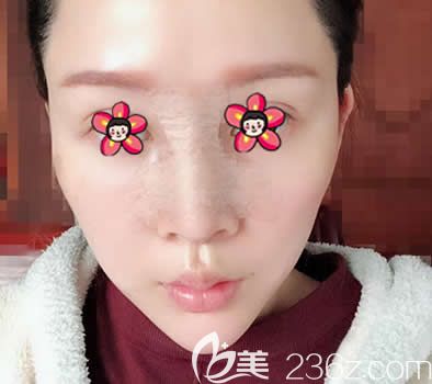 嘉興禾美整形曹海峰隆鼻案例即刻效果